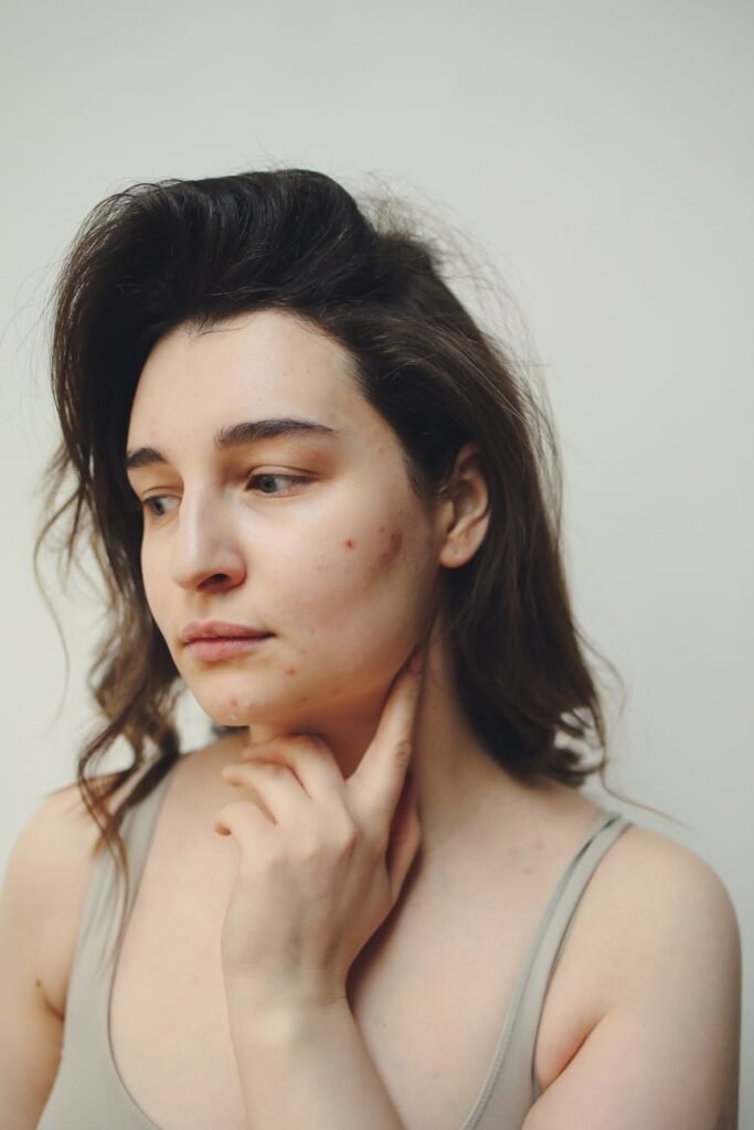 portrait of a woman with acne